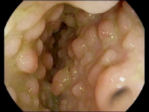 FAP polyps