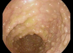 FAP polyps