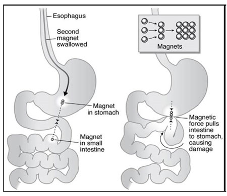 Illustration of what happens when magnets are ingested