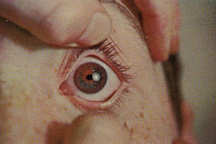 Wilson's Disease eye rings
