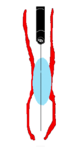 Diagram of balloon dilation
