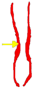 Diagram of a narrow esophagus (food pipe)
