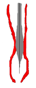 Diagram of mechanical dilation